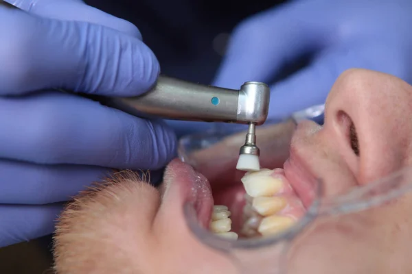 Dentista Limpia Los Dientes Del Paciente Preparación Cavidad Oral Para — Foto de Stock