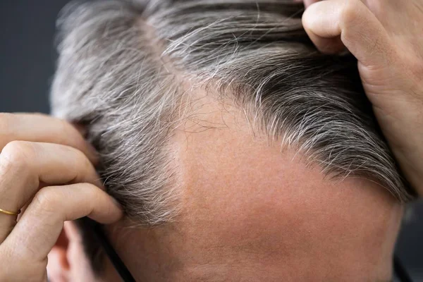 Mann Mit Glatze Verliert Haare Kontrolle Des Haarausfalls Auf Der — Stockfoto