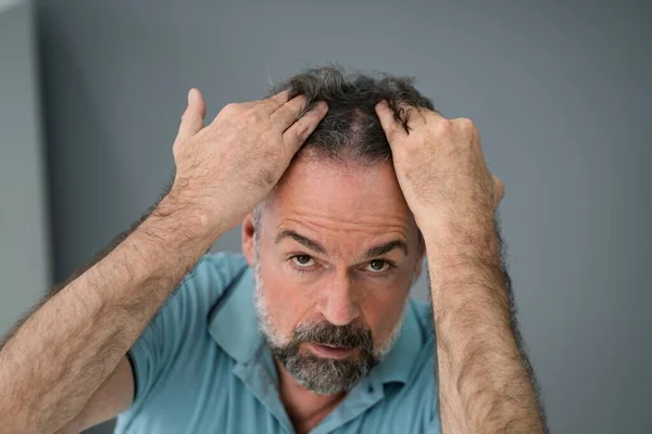 Mann Überprüft Seinen Haarausfall Und Schuppen — Stockfoto