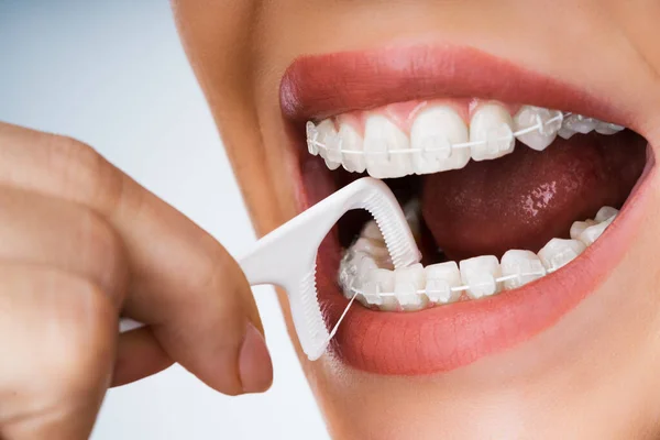 フロススティックを使用して口の中で女性のクリーニング歯科用ブラケット — ストック写真