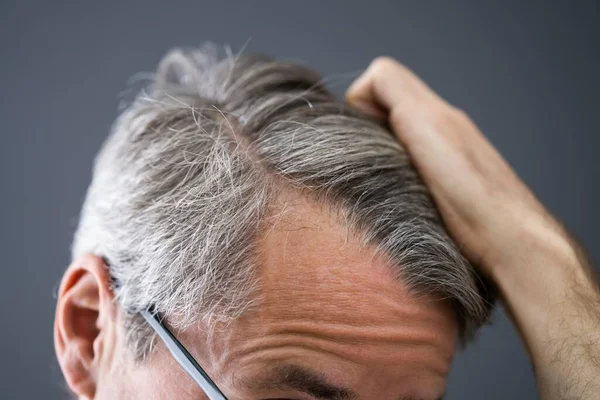 Mann Mit Glatze Verliert Haare Kontrolle Des Haarausfalls Auf Der — Stockfoto