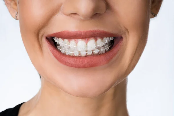 Boca Feminina Com Metal Branco Dental Braces Suportes — Fotografia de Stock