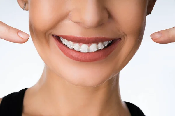 Boca Feminina Com Metal Branco Dental Braces Suportes — Fotografia de Stock