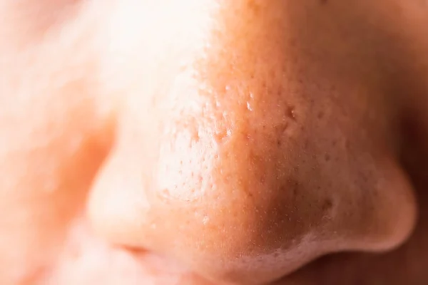 Closeup Asian Young Woman Large Pores Have Freckles Cheek Oily — Stock Photo, Image