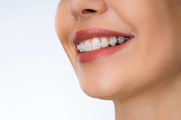 Female Mouth Metal White Dental Braces Brackets — Stock Photo, Image