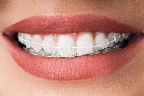 Kobiece Usta Metalowymi Białymi Aparatami Dentystycznymi Lub Wspornikami — Zdjęcie stockowe