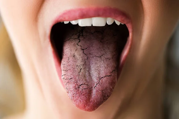 Lengua Femenina Con Malas Bacterias Candidiasis Dolor —  Fotos de Stock