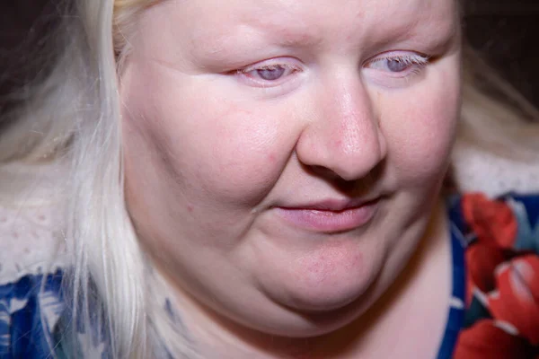 Extreme Nahaufnahme Einer Traurigen Albino Frau — Stockfoto