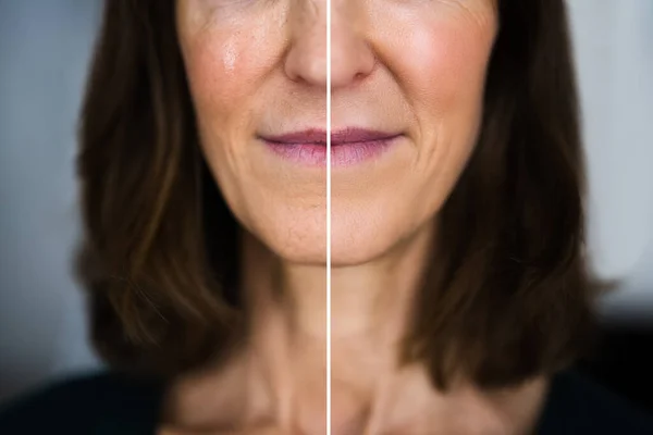 Rejuvenation Wrinkles Lift — Stock Photo, Image
