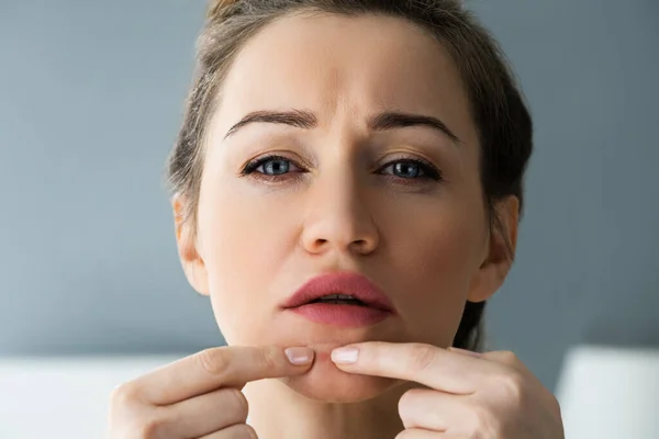 Mujer Mejilla Grano Dermatología Problema Piel — Foto de Stock