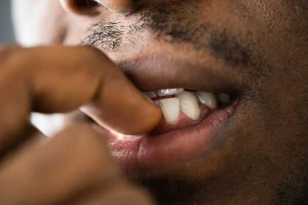 Unghie Nevrotiche Che Mordono Mani Bocca — Foto Stock