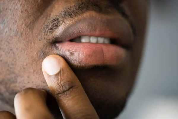 Africké Americké Ústa Rty Kůže Herpes Léčba — Stock fotografie