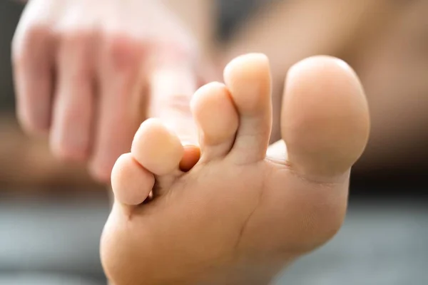 Sporcu Ayak Mantarı Enfeksiyonu Parmaklar Arasında Kaşınma — Stok fotoğraf