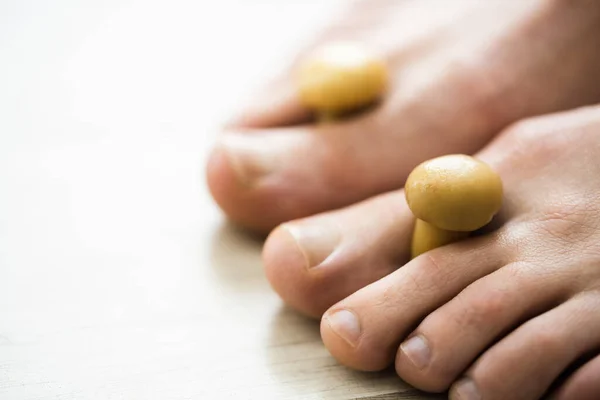 Schimmel Paddenstoel Tussen Toenail Stinkende Voeten Schimmels — Stockfoto