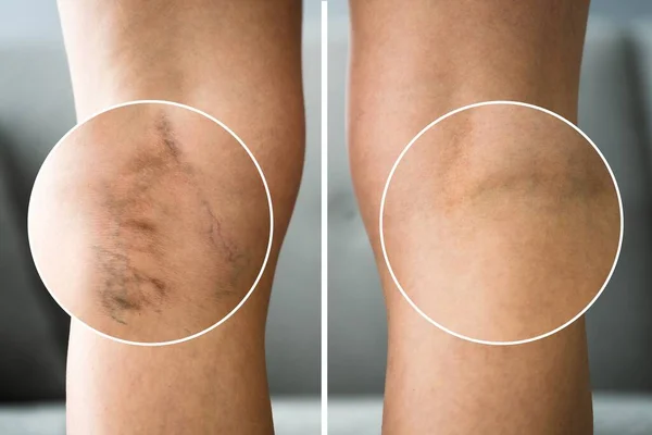 Antes Después Celulitis Inflamación Piernas Tratamiento Primer Plano —  Fotos de Stock