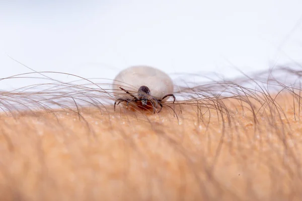 Tick Ixodes Ricinus Pada Kulit Manusia Yang Penuh Dengan Darah — Stok Foto