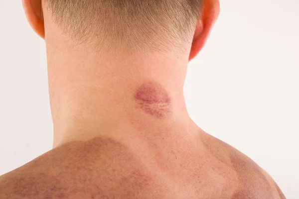 Cupping Marcas Terapia Nas Costas Homem Bonito Conceito Massagem Bem — Fotografia de Stock