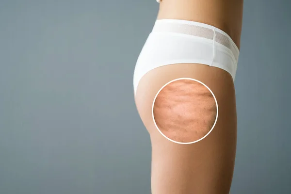 Celulite Inflamação Nas Pernas Closeup Lipoaspiração Médica — Fotografia de Stock