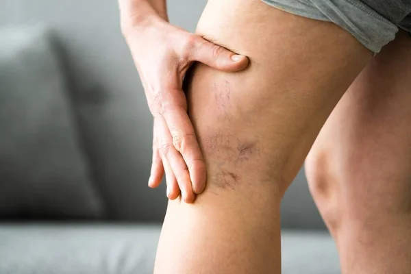 Selülit Ltihaplanma Sonrası Bacak Tedavisi Kapanmasından Önce — Stok fotoğraf