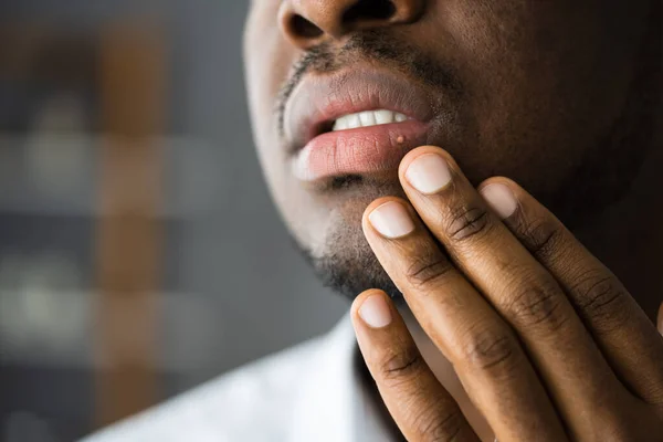African American Mouth Lip Skin Herpes Treatment — Stockfoto