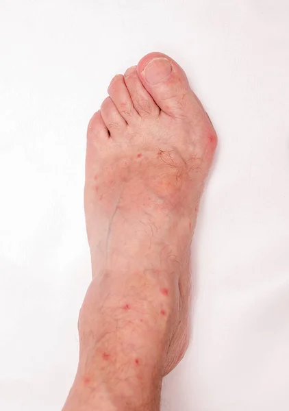 Foot of a man with advanced stage bunion (Hallux abductus valgus)