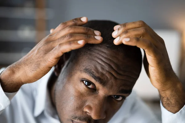 Jovens Africano Homens Perda Cabelo Assistindo Queda Cabelo — Fotografia de Stock