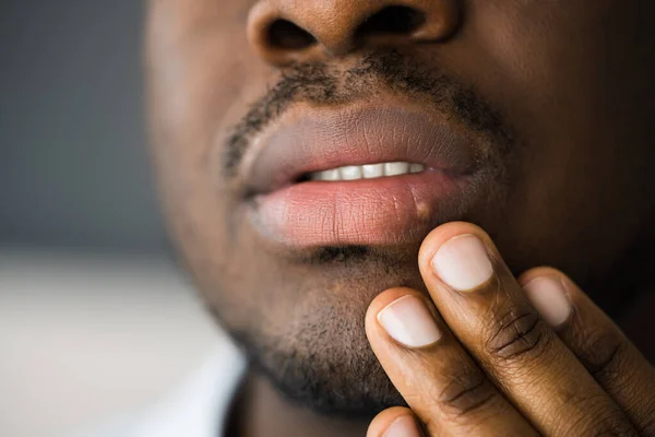 African American Mouth Lip Skin Herpes Treatment — Stockfoto