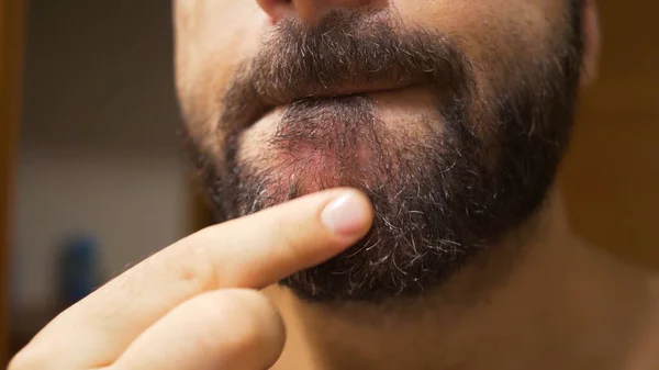 Detalhe Queixo Homem Com Dermatite Seborreica Área Barba Pele Seca — Fotografia de Stock