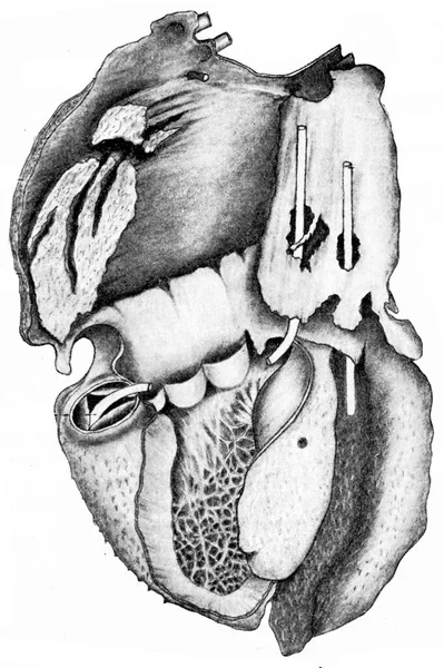 Corazón Mostrando Pericarditis Vellosa Ilustración Grabada Vintage — Foto de Stock