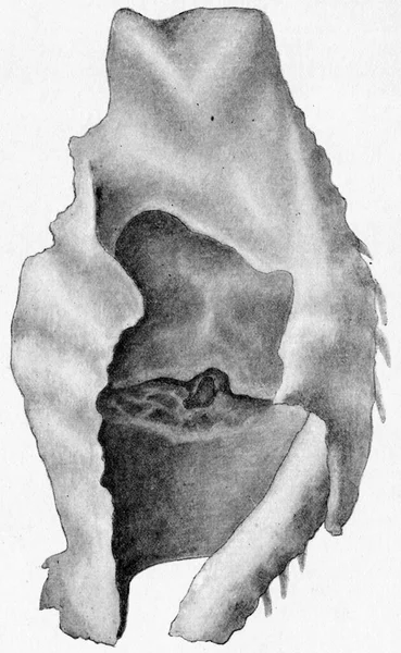 Perichondritis Met Laryngeale Ulceratie Vintage Gegraveerde Illustratie — Stockfoto