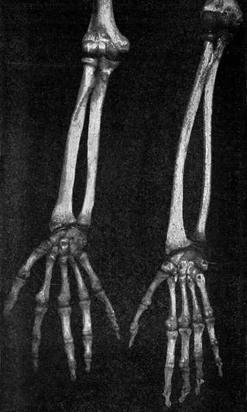 前臂的骷髅和一个日本人和一个澳大利亚人的手 古老的雕刻插图 1910年来自宇宙与人类 — 图库照片