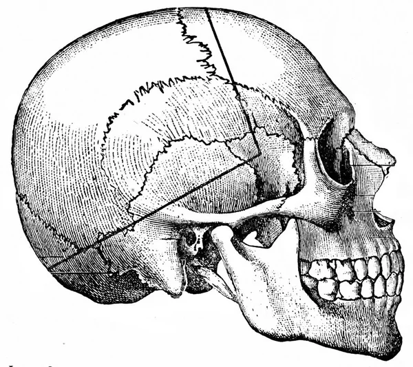 Heavy Line Indicating Course Taken Saw Cut Called Undertaker Method — Stock Photo, Image