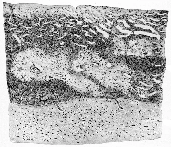 Seção Córtex Cerebral Meninges Caso Meningite Supurativa Ilustração Gravada Vintage — Fotografia de Stock