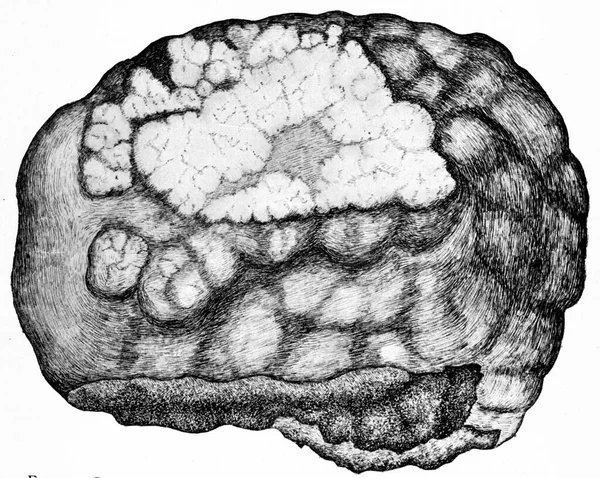 Partie Lobe Gauche Foie Montrant Carcinome Primitif Cellules Cylindriques Illustration — Photo