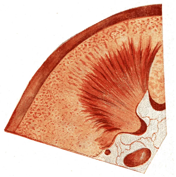 Νεφρική Οξεία Παρεγχυματώδης Νεφρίτιδα Vintage Εγχάρακτη Απεικόνιση — Φωτογραφία Αρχείου
