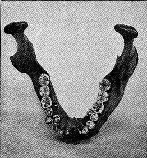Mandíbula Inferior Australiano Con Tres Premolares Cada Lado Ubicación Molar — Foto de Stock