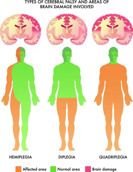 Illustration Médicale Des Types Paralysie Cérébrale Des Zones Lésions Cérébrales — Image vectorielle