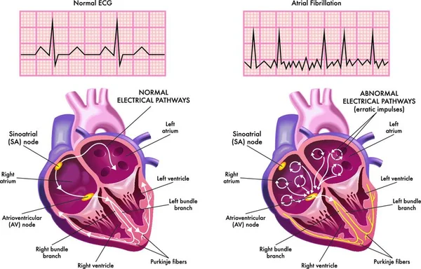 Medical Illustration Showing Symptoms Heart Atrial Fibrillation Compared Normal One — Stock Vector