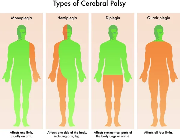 Formes Paralysie Cérébrale Illustrées Dans Schéma Médical — Image vectorielle