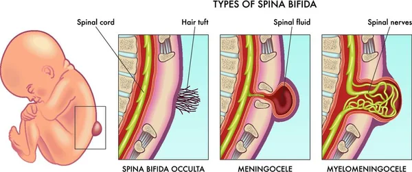 Ilustración Médica Espina Bífida Infantil Con Anotación — Archivo Imágenes Vectoriales