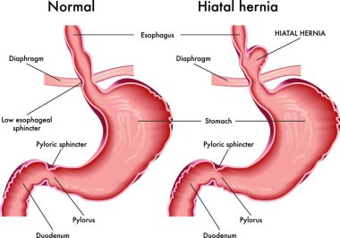 Medical illustration that compares a normal stomach and one with a hiatal hernia. clipart