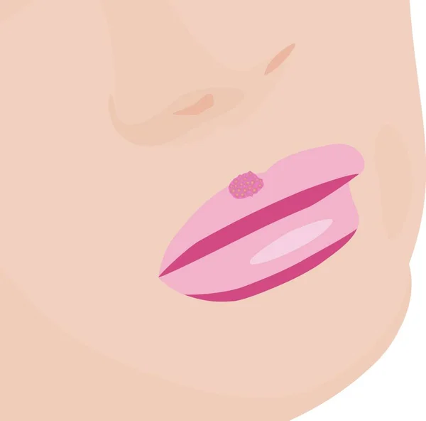 Ampollas Debido Herpes Labial Los Labios Vector Ilustración Infección Por — Vector de stock