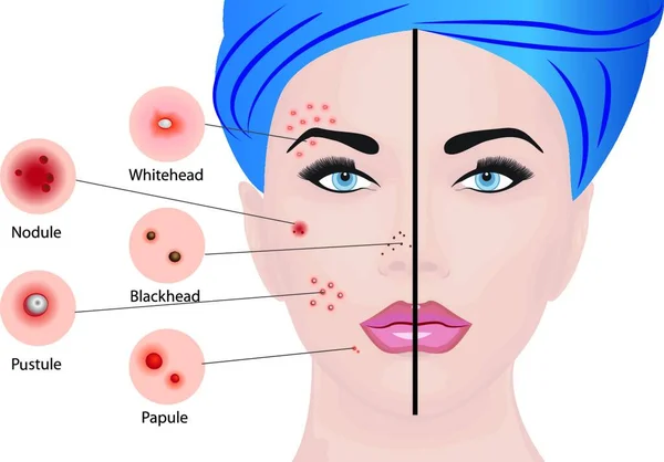 Acne Types Een Vrouw Gezicht Vector Illustratie Cosmetologie Concept Huidziekte — Stockvector