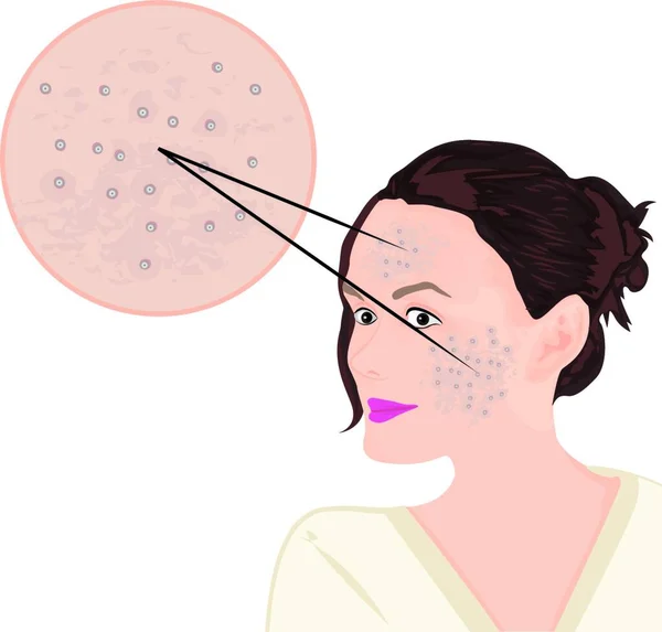 Acné Una Ilustración Del Vector Facial Que Muestra Problema Piel — Vector de stock