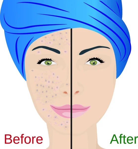 Pustulas Acne Rosto Mulher Resultado Tratamento Antes Depois Ilustração Vetorial — Vetor de Stock