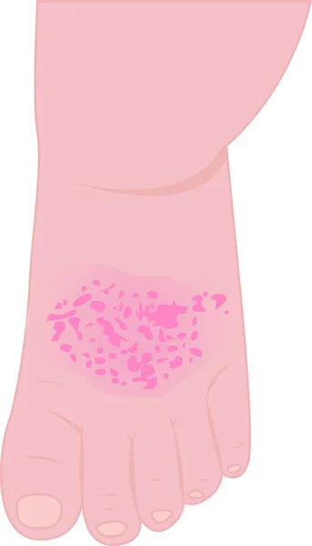 在隔离的白色背景上 湿疹向量插图影响的婴儿脚 — 图库矢量图片