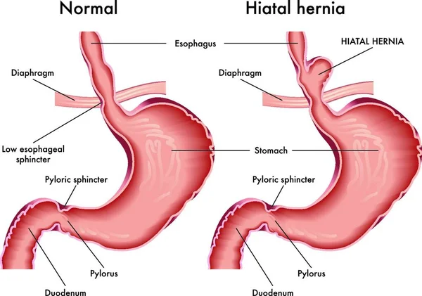 Ilustração Médica Que Compara Estômago Normal Com Uma Hérnia Hiatal —  Vetores de Stock