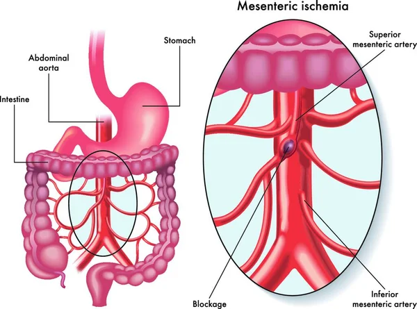 Ilustración Médica Que Muestra Una Isquemia Mesentérica También Llamada Infarto — Archivo Imágenes Vectoriales