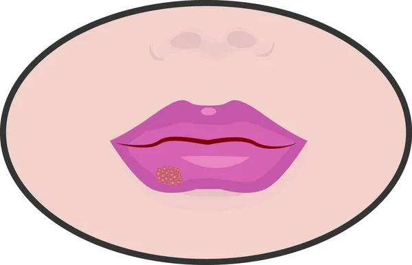 Herpes Cold Sores Lips Vector Illustration White Background Isolated — Stock Vector