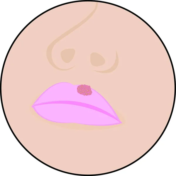 Herpes Lips Cold Sores Viral Infection Vector Illustration — Stock Vector